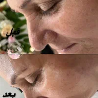 درمان تیرگی بدن،مشاوره هوم کر، فیشال تخصصی، لیزر
