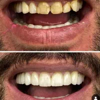 خدمات کامپوزیت ،لمینت،ایمپلنت