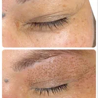 برداشتن گوشت اضافه صورت وبدن|خدمات آرایشگری و زیبایی|اصفهان, کوجان|دیوار