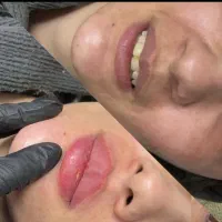 ژل بوتاکس فیلر فیشیال مزوتراپی توسط پزشک مجرب|خدمات آرایشگری و زیبایی|شهریار, شهریار|دیوار