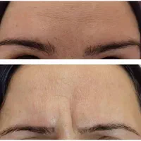 لیزرموهای زائدبادستگاه آلمانی+فیلر+بوتاکس+مزوتراپی|خدمات آرایشگری و زیبایی|کرمان, |دیوار
