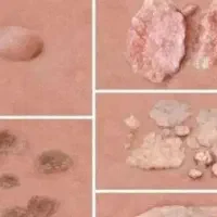 پاکسازی زگیل تناسلی وتبخال تناسلی