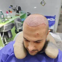 کاشت مو کاشت ابرو سوپر لیفت.وغیره...