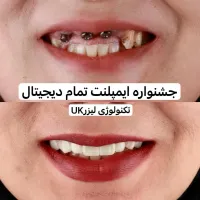 کلینیک تخصصی ایمپلنت دیجیتال/فوری/یکروز/کاشت دندان