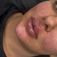 آموزش ژل و‌ بوتاکس و فیلر بادی به جدید‌ترین روش‌