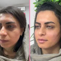 ژل بوتاکس فیلر فیشیال مزوتراپی توسط پزشک مجرب|خدمات آرایشگری و زیبایی|شهریار, شهریار|دیوار