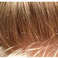 داروشپش.درمان شپش و رشک|آرایشی، بهداشتی، درمانی|گلبهار, شهر جدید گلبهار|دیوار