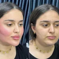 تخفیفات استثنایی ژل و بوتاکس در مطب زیبایی|خدمات آرایشگری و زیبایی|قم, دورشهر|دیوار