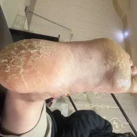 پدیکور، درمان اسیب های پا درچناران