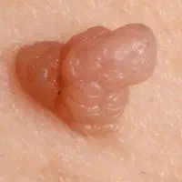 رفع زگیل تناسلی