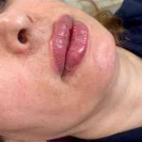 تزریقات ژل و بوتاکس با مناسبترین‌ قیمت