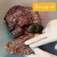 بهبودی کامل کبد چرب کمتر از یک دوره