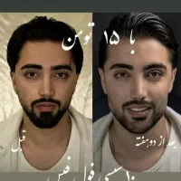 بوتاکس۹۹۰ ژل لب فقط ۸۹۰