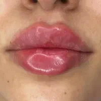 تزریق ژل لب و فیلرر مزو جوانساز