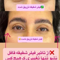 جشنواره ژل و بوتاکس توسط پزشک|خدمات آرایشگری و زیبایی|کرمانشاه, |دیوار