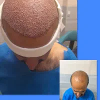 کاشت مو وابرو طبیعی تضمینی در تهران