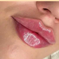 جوانسازی ژل و مزوژل و..