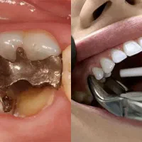 کشیدن دندان معمولی۲۹۰ فقط سه شنبه ها