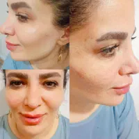 اموزش و خدمات بوتاکس و فیلروفیشیال و فیلر بادی|خدمات آرایشگری و زیبایی|شیراز, کوشک میدان|دیوار