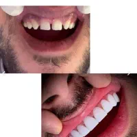 کامپوزیت دندان ، عصب کشی و روکش
