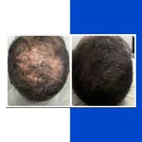 یه بار برای همیشه درمانش کن