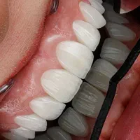 دندانپزشکی ایمپلنت کامپوزیت روکش لمینت‌ ارتودنسی|خدمات آرایشگری و زیبایی|تبریز, |دیوار