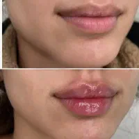 کرم پودردائم تزریق ژل بدون سوزن مزونیدلینگ پلکسر