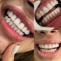 تخفیف کامپوزیت ونیر دندان|خدمات آرایشگری و زیبایی|اردبیل, |دیوار