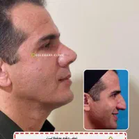 جشنواره تخفیفات تابستانه جراحی بینی،صورت،پیکرتراشی|خدمات آرایشگری و زیبایی|کرج, مهرویلا جنوبی|دیوار