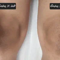ژیکان لیزر موهای زائد،ریمو تتو،فشیال|خدمات آرایشگری و زیبایی|قم, زنبیل آباد|دیوار