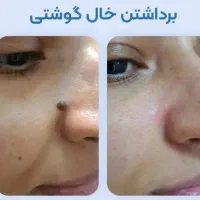 خالبرداری باموادگیاهی زیر نظرداروساز باتجربه
