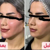 آموزش ژل فیلر لب چانه انزیم چاقی صورت مزو مو فشیال|خدمات آرایشگری و زیبایی|قم, زنبیل آباد|دیوار