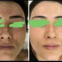 کرم گلدن کوین دفع کک ومک ولک و جای جوش اصلی|آرایشی، بهداشتی، درمانی|کرمانشاه, |دیوار