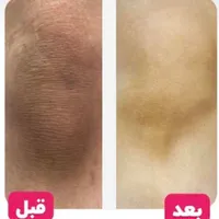 جشنواره لیزر موهای زائد تیتانیوم‌۲۰۲۵و پلینگ کربن|خدمات آرایشگری و زیبایی|شیراز, معالی‌آباد|دیوار