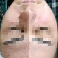 مدل فشیال (پاکسازی با دستگاه)