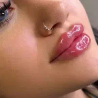 تزریق ژل لب روسی/بوتاکس