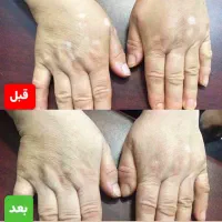 درمان بیماریهای پیسی وپسوریازیس واگزما  دائمی|خدمات آرایشگری و زیبایی|گرگان, |دیوار