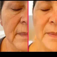 کرم ضد چین چروک(جایگزین بوتاکس)