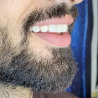 زیبایی دندان مصنوعی