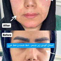 ریموو تاتو/ریزش سکه ای/مزوتـراپی/خال بـرداری/فیشال|خدمات آرایشگری و زیبایی|شیراز, طلاب|دیوار