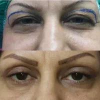 جراحی بلفاروپلاستی|خدمات آرایشگری و زیبایی|تهران, ده‌ونک|دیوار