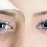 مدل رایگان جوانساز زیر چشم