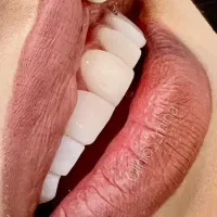 آف روکش وپل دندان ، کامپوزیت با قیمت مناسب