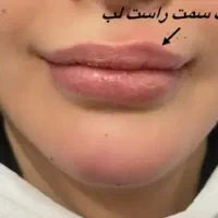 تزریق ژل ( فیلر ) بوتاکس مزو نخ کانتورینگ عربی|خدمات آرایشگری و زیبایی|تهران, صادقیه|دیوار