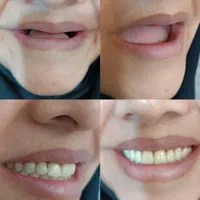 پروتز دندان (دندان مصنوعی)|خدمات آرایشگری و زیبایی|تربت‌حیدریه, بازار|دیوار