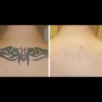 جشنواره لیزر ریموو تتو و موی زائد در مطب پزشک