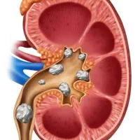دفع صددرصدی سنگ کلیه