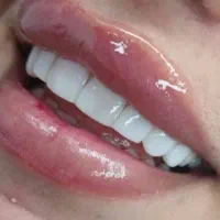 خدمات ژل ، بوتاکس، مزوتراپی ،فشیال و کامپوزیت|خدمات آرایشگری و زیبایی|اهواز, ۲۴ متری|دیوار