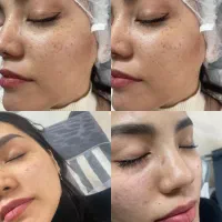 تخصصی ترین مرکزپوستی وزیبایی حذف تمامی لک هاکک مک|خدمات زیبایی و سلامت|قم, زنبیل آباد|دیوار