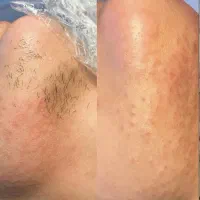 الکترولیز موهای زائد و (آموزش تخصصی الکترولیز)